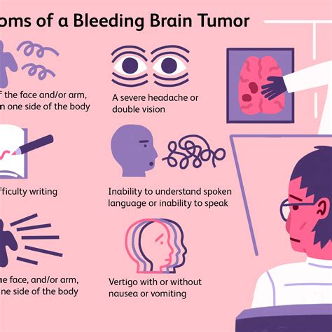 After College Experience: Can A Stroke Cause A Brain Bleed