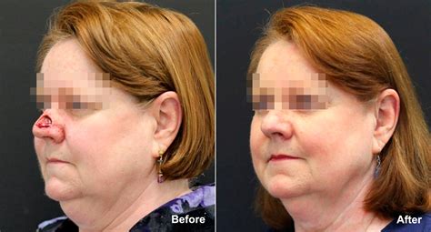 Reconstructive Surgery Photos | Princeton, NJ | Patient 9832