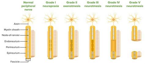 Classification of Peripheral Nerve Injury - Physiopedia