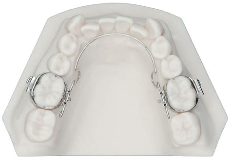 3D Lingual Arch - Protec Dental