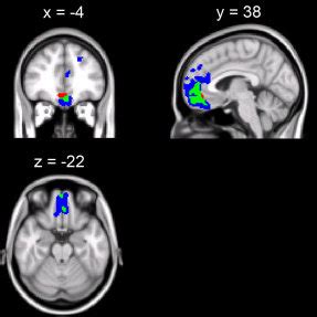 Brain regions that are correlated with general fluid intelligence. A ...