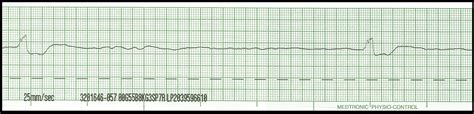 EKG Rhythm Strips 91 Various Agonal Rhythms