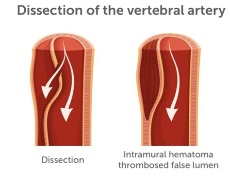 vertebral artery dissection – Dr. Daliah