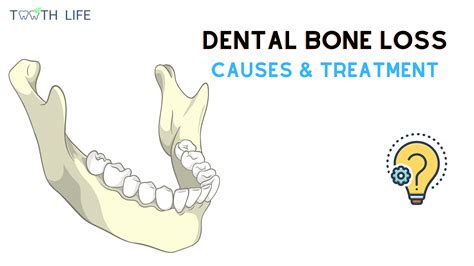 Bone loss in teeth and your treatment options