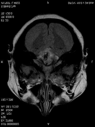 Axial T2-MRI image of the right pontine lesion, with the typical... | Download Scientific Diagram