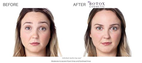 Botox Before and After | Real Patient Results in Chatham