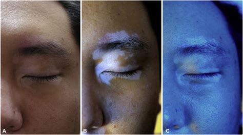 365-nm narrowband Wood's lamp for vitiligo and hypopigmentation disorders - Journal of the ...