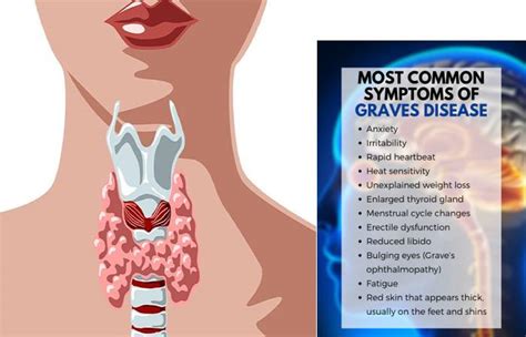 What is Graves' Disease? - Definition, Symptoms, Causes, and More