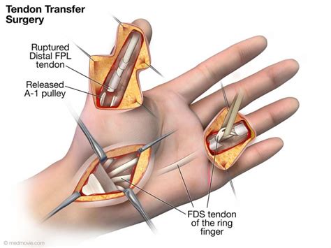 Medmovie.com | Tendon Rupture Following Trigger Finger Release