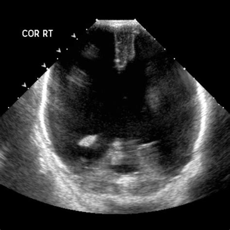 Hydranencephaly Ultrasound