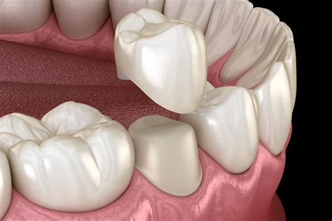 Dental Crowns in TX | General Dentistry Services Conroe