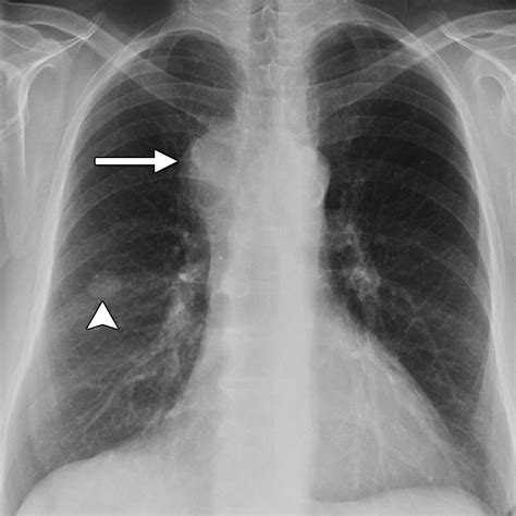 Small Cell Lung Carcinoma: Staging, Imaging, and Treatment ...