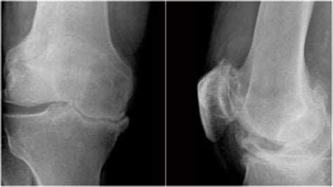 This drug may improve knee osteoarthritis in people: Study | This News ...