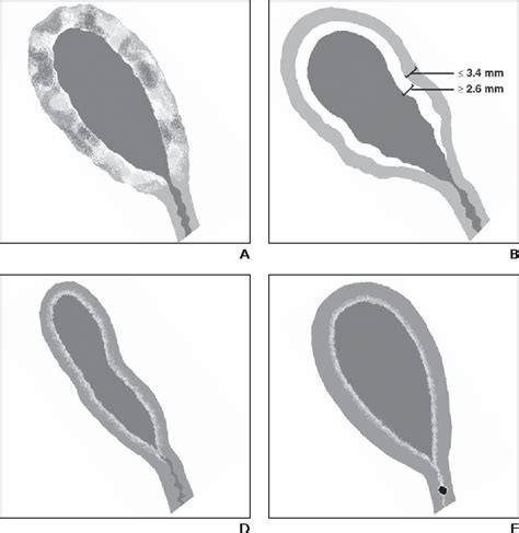 Figure 1 from Analysis of enhancement pattern of flat gallbladder wall thickening on MDCT to ...