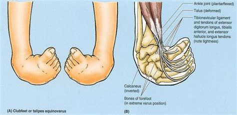 equinovarus foot - Google Search | Pediatric physical therapy, Club foot baby, Flashcards