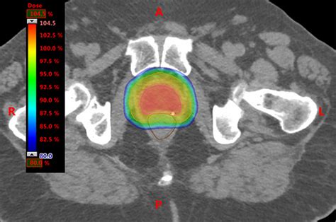 RACGP - Advances in radiotherapy technology for prostate cancer: What ...