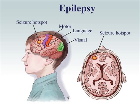 EPILEPSY What Are Seizures and Epilepsy? Epilepsy is a medical condition where a person has ...