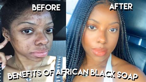 African Black Soap Uses And Benefits for Hyperpigmentation, Acne and MORE - YouTube