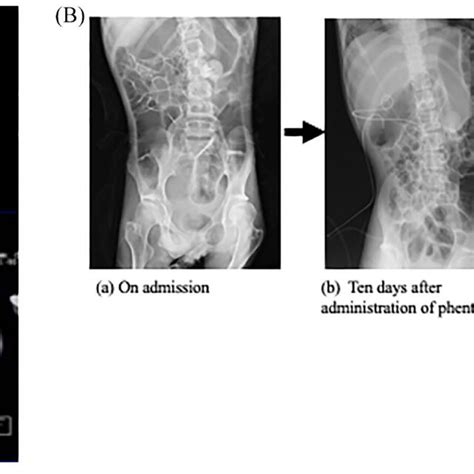 (A) Imaging findings results of the CT scan and ¹²³I-MIBG scintigraphy.... | Download Scientific ...