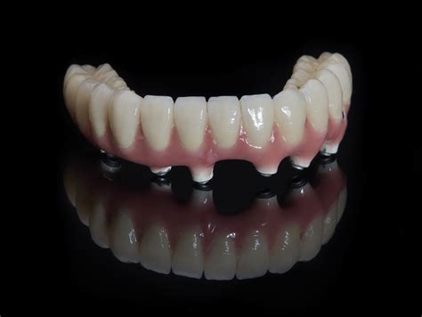 How Do Implant Dentures Work? - General and Cosmetic Dentistry | Rotem Dental Care