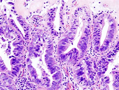 File:Gallbladder adenocarcinoma (2) histopathology.jpg - Wikipedia