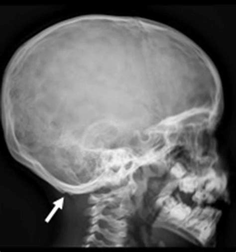 Occipital horn syndrome causes, symptoms, diagnosis, treatment & prognosis