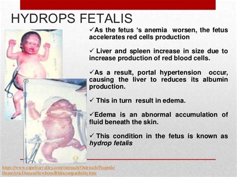 Prevention of hemolytic disease of the newborn