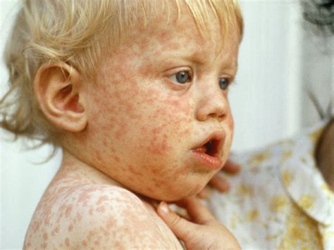 Measles | BabyCenter