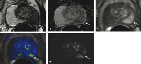 Dynamic Contrast-Enhanced MRI of the Prostate | Radiology Key