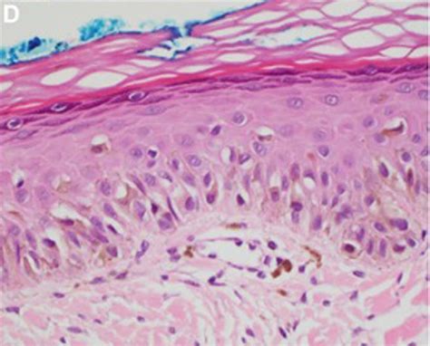 Lentigo Maligna Melanoma Histology