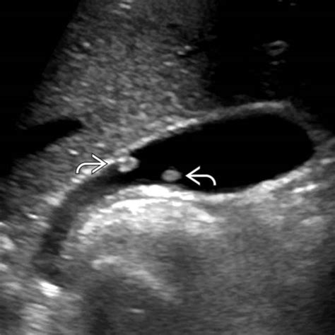 Gallbladder Polyps Ultrasound