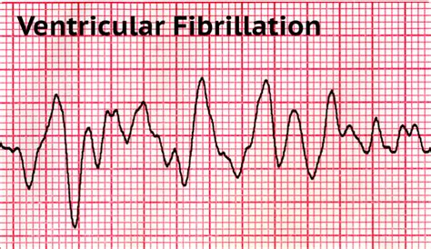 What Is Ventricular Fibrillation: Symptoms And Causes - First Aid ...