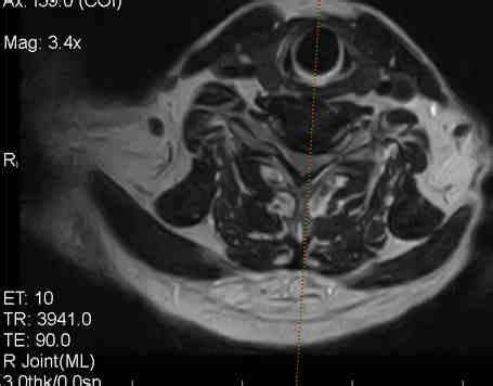 -MRI scan: Left C6 – C7 herniated disc Figure 5 -MRI scan: Left C6 – C7... | Download Scientific ...