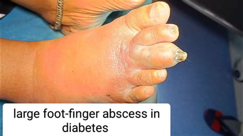 large foot finger abscess in diabetes patient | debridement | drainage | #dr #youtube#surgery ...