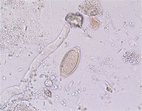 Trichuris trichiura | Medical Laboratories