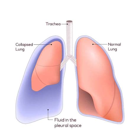 Pleural Effusion Treatment in Singapore - Dr Aneez | Thoracic Doctor