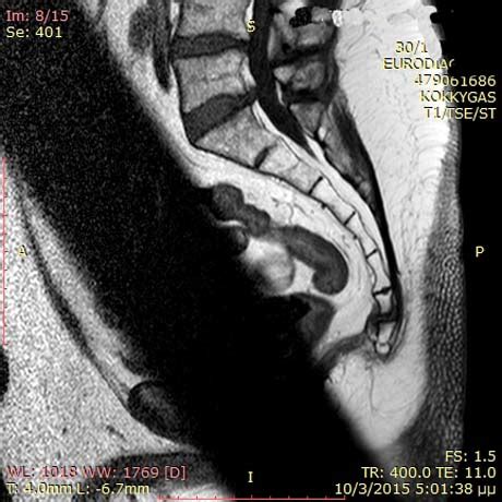 TAILBONE INJURY - COCCYX PAIN - COCCYDYNIA | GEORGE D. GOUDELIS MD. Ph.D.