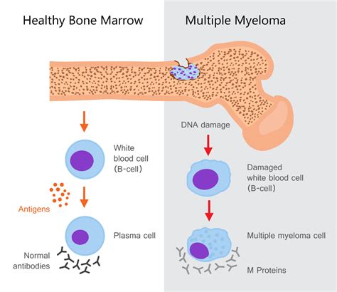 Physiotherapy in Multiple Myeloma Treatment