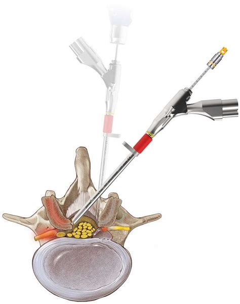 Endoscopic Discectomy | Scottsdale, AZ Orthopedic Spine Surgery