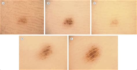 Variations in the Dermoscopic Features of Acquired Acral Melanocytic ...