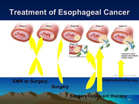 11 esophageal cancer