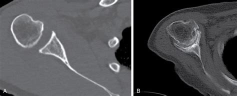 Opinion editorial—reconstructing the glenoid in total shoulder ...