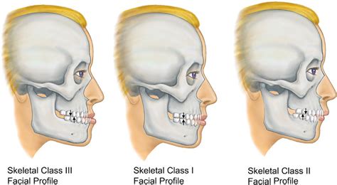 Illustrates Class I, Class II, and Class III facial skeletal profiles.... | Download Scientific ...