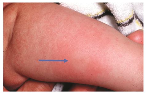 Cow’s milk protein allergy arising in infancy has two mechanisms | New ...