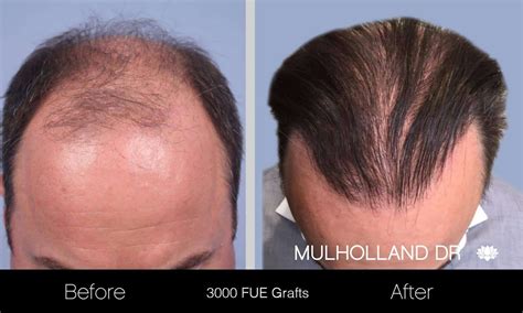 ARTAS Hair Transplant | Toronto Plastic Surgeons