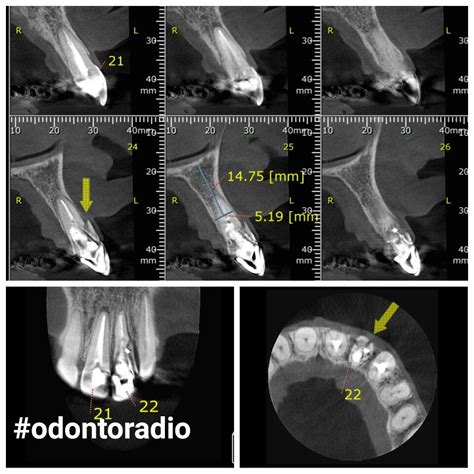 Fratura radicular. #odontoradio #radiologia #radiology #tomografia # ...