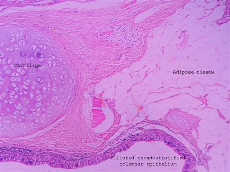 Dermoid cyst – ovary – Histopathology.guru