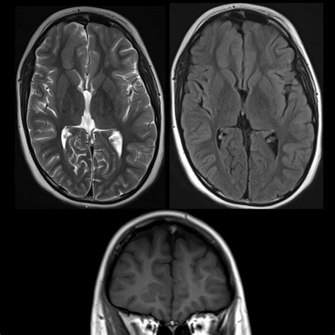 School ager with seizures | Pediatric Radiology Case | Pediatric Imaging | @pedsimaging ...