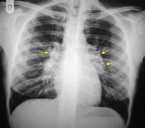 Bihilar lymphadenopathy - Radiology at St. Vincent's University Hospital