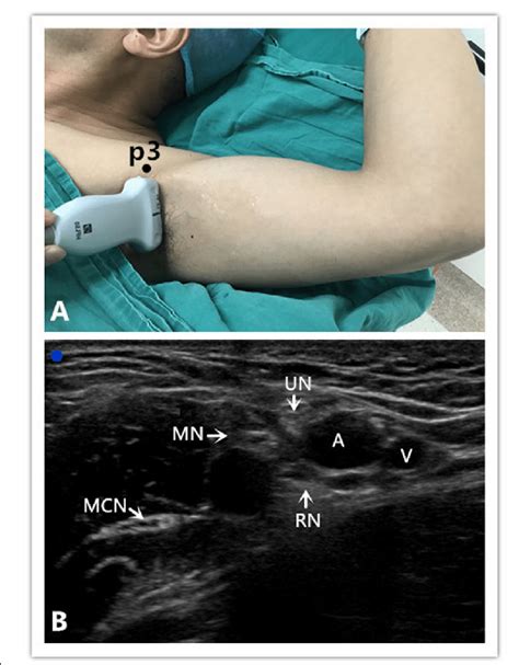 Axillary Nerve Block